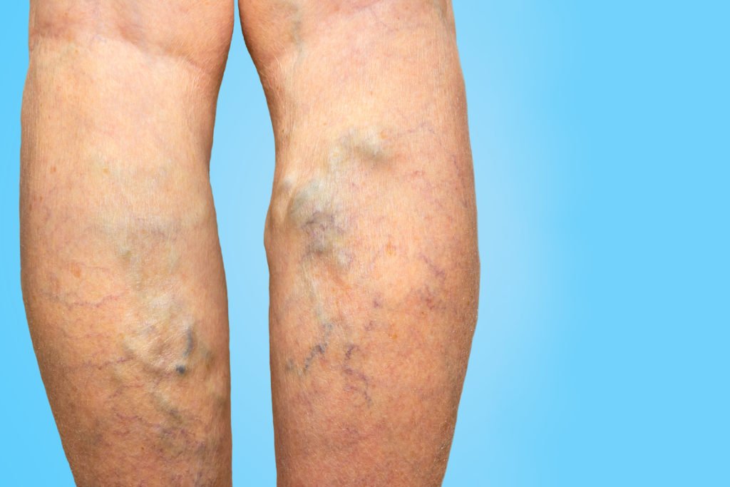 Common Misconceptions Revolving Around the Varicose Vein