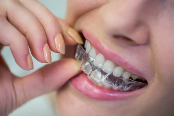 Invisalign Treatment
